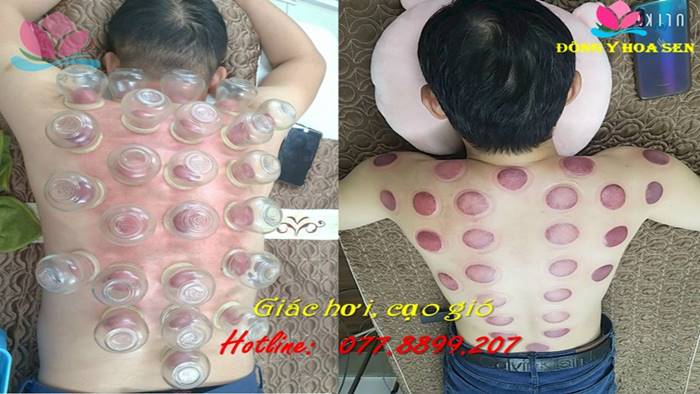 cạo gió giác hơi ở đâu