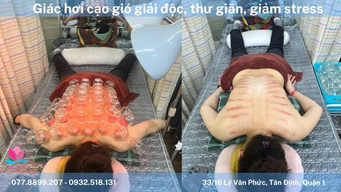 cạo gió giác hơi tại nhà