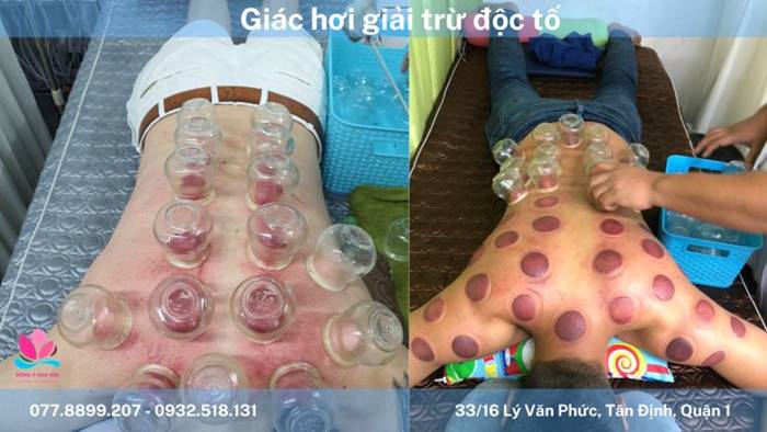 cạo gió giác hơi tại nhà