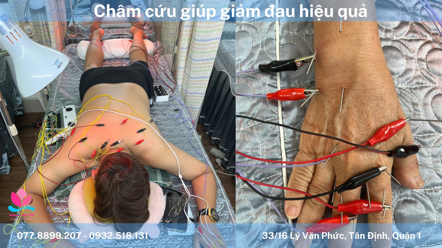 Châm cứu chữa mất ngủ