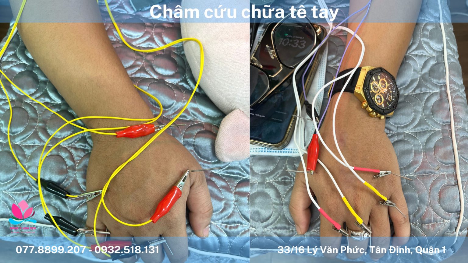 Châm cứu chữa mất ngủ