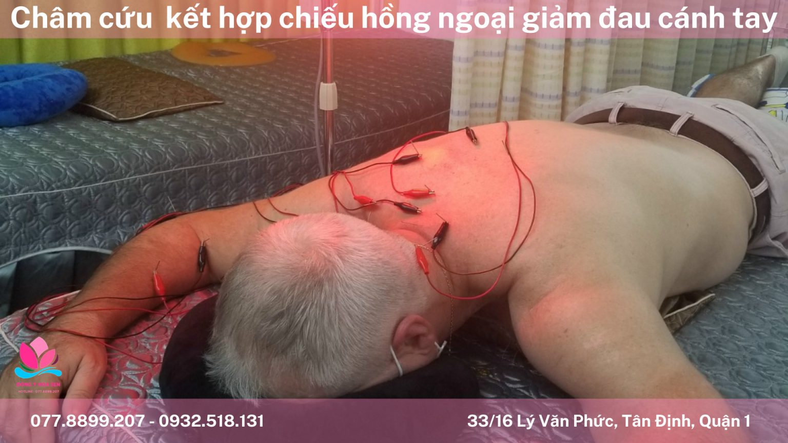 Châm cứu đau lưng