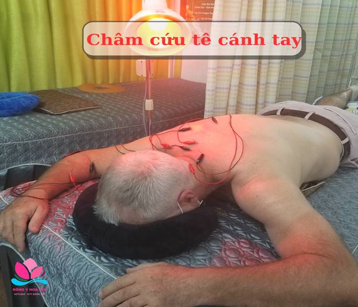 Điện châm