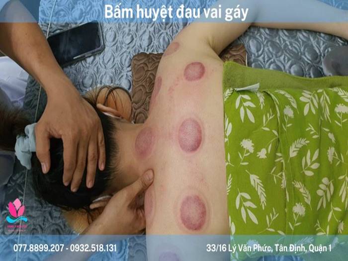 Huyệt vùng vai gáy