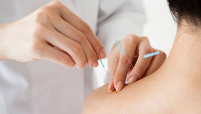 Mách bạn những điều kiêng cử khi châm cứu