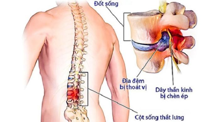 Thoát vị đĩa đệm