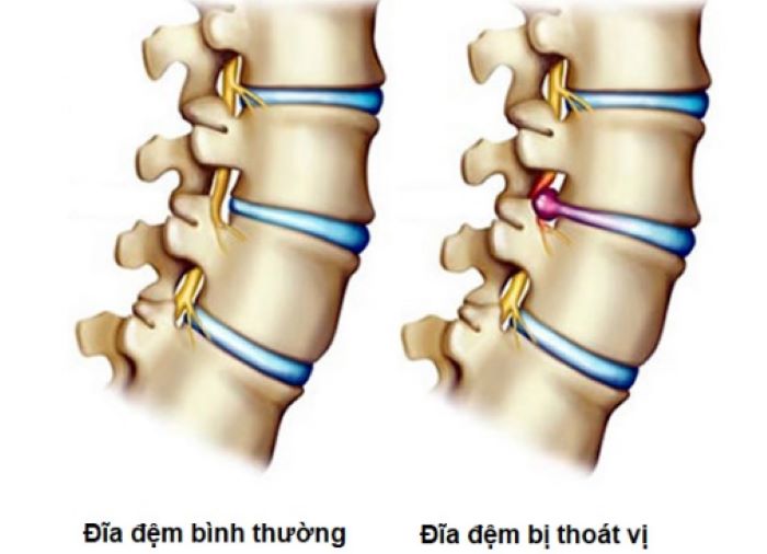 Thoát vị đĩa đệm