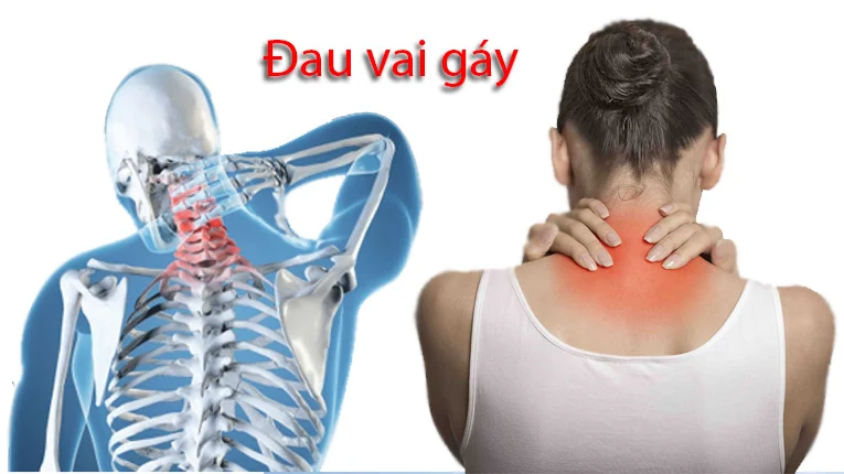 đau vai gáy