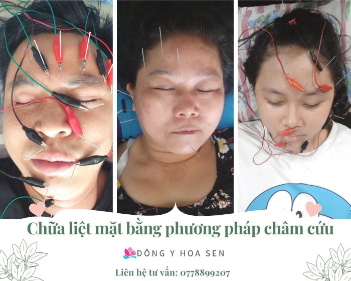 nơi khám liệt dây thần kinh số 7