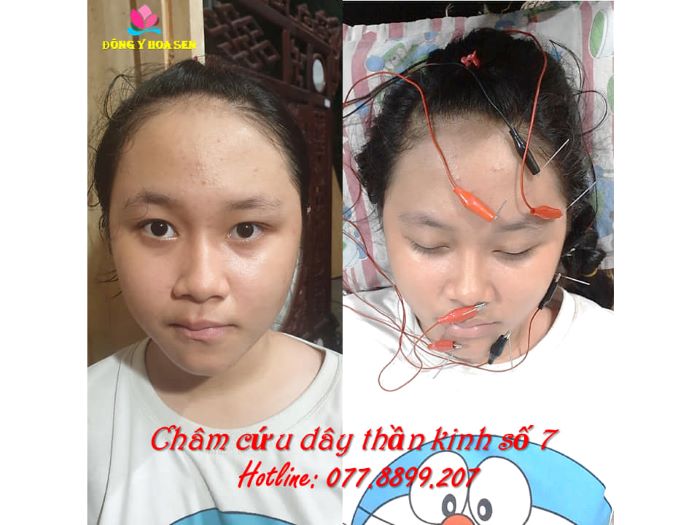 nơi khám liệt dây thần kinh số 7