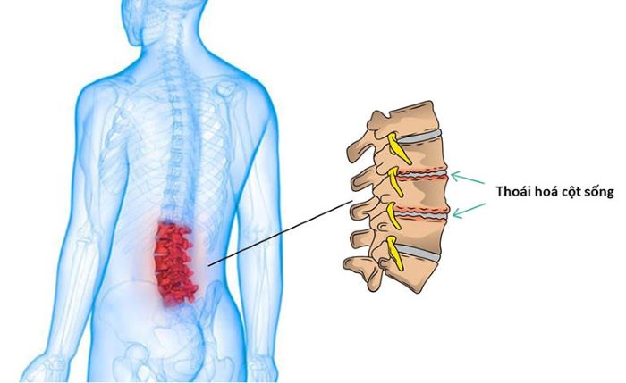 thoái hóa cột sống lưng