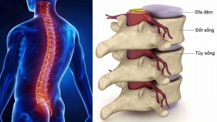 thoái hóa cột sống lưng
