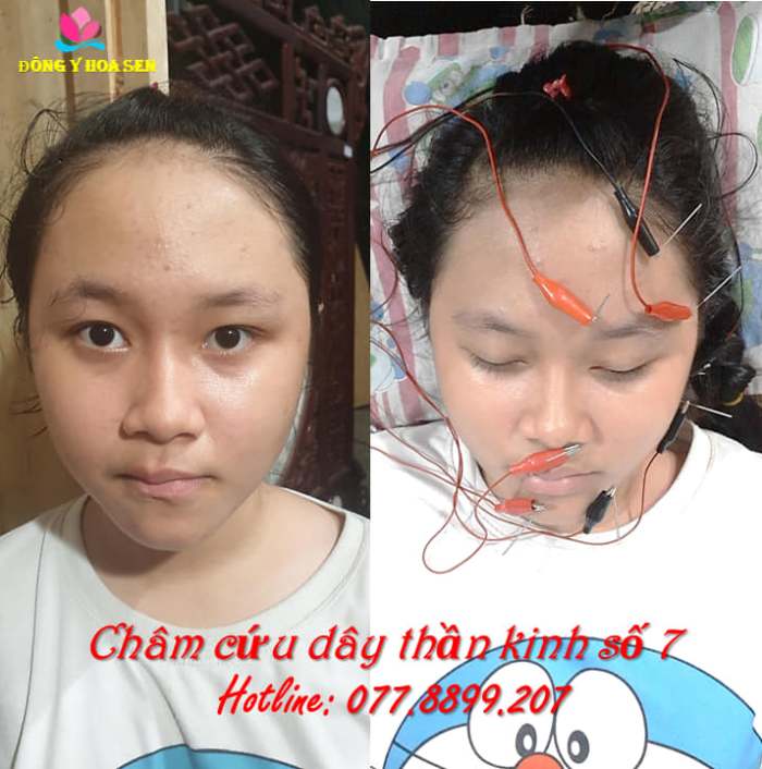 Châm cứu liệt dây thần kinh số 7