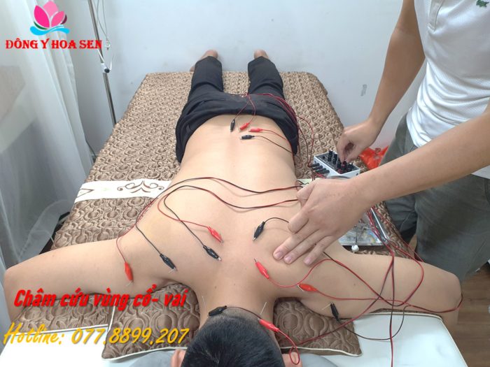Điều trị thoái hóa cột sống bằng đông y
