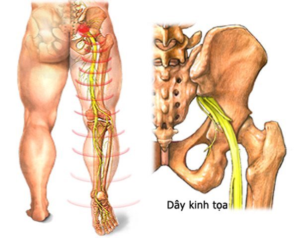 bấm huyệt chữa thần kinh tọa