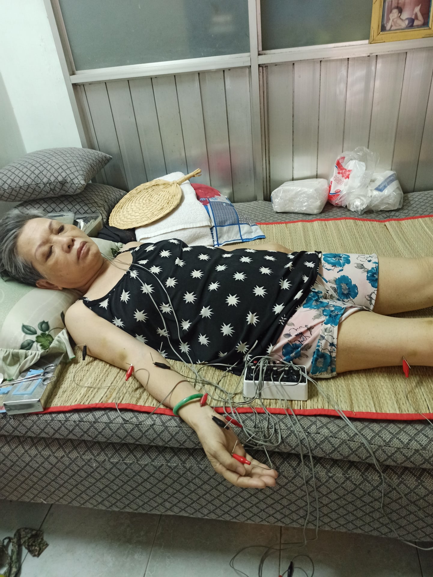 Châm cứu tại nhà giá bao nhiêu