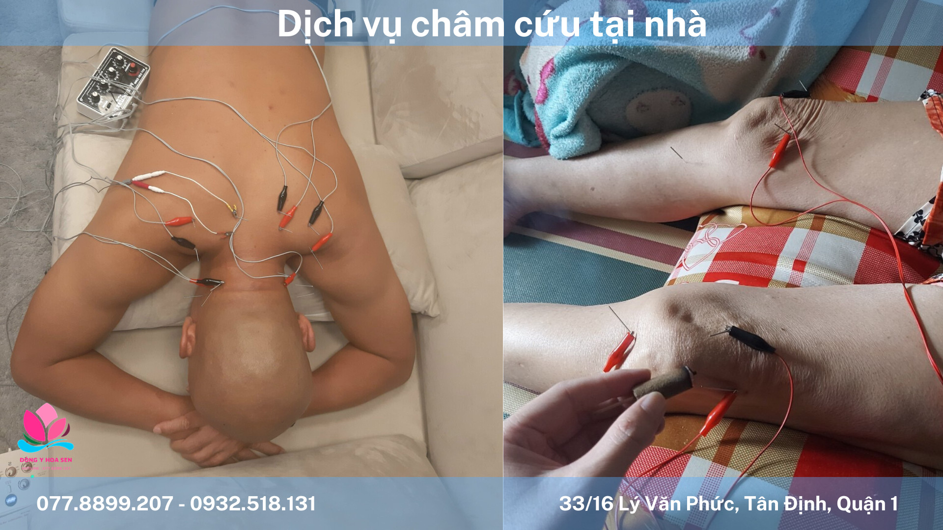 dịch vụ châm cứu tại nhà 