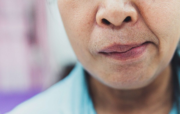 vật lý trị liệu liệt mặt dây 7