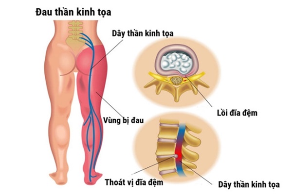 đau thần kinh tọa